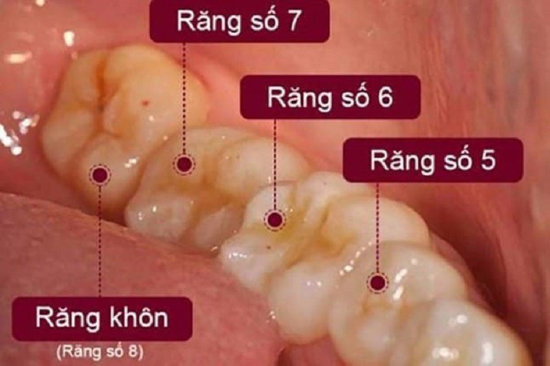 Răng số 7 hay còn gọi là răng cối lớn có vai trò nhai chính