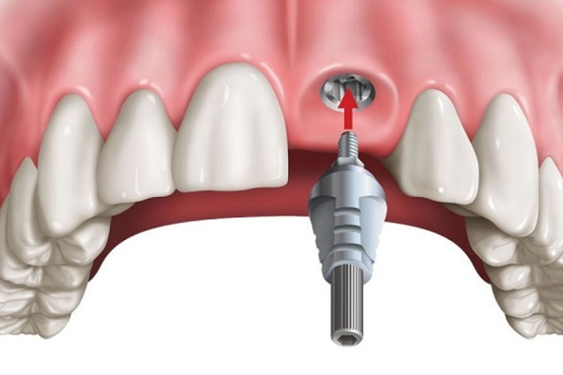 Trồng răng số 7 với phương pháp cấy ghép Implant