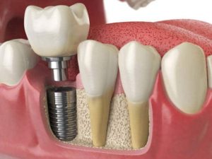 Những phương pháp trồng răng số 7 có hiệu quả tốt nhất