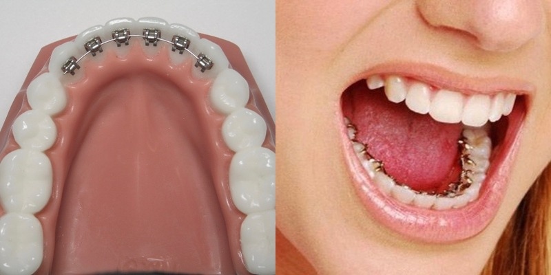 Niềng răng mặt trong là phương pháp được sử dụng khá phổ biến