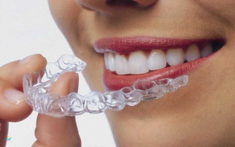 Niềng răng trong suốt là phương pháp chỉnh nha không cần khí cụ niềng