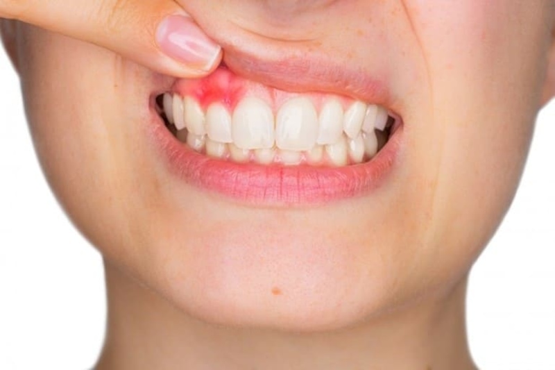 Các bệnh lý răng miệng là yếu tố ảnh hưởng tới giá thực hiện