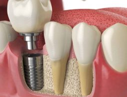 [Giải đáp] Bảng giá trồng răng Implant bệnh viện Răng Hàm Mặt