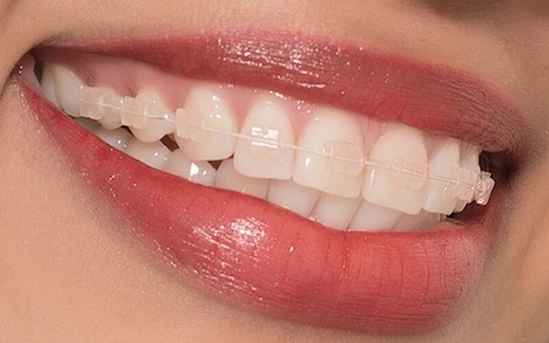 Giá niềng răng sứ cao hơn so với niềng răng mắc cài kim loại