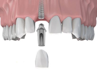 Trồng Răng Implant Hàn Quốc - 5 Thông Tin Cần Biết Trước Khi Lựa Chọn