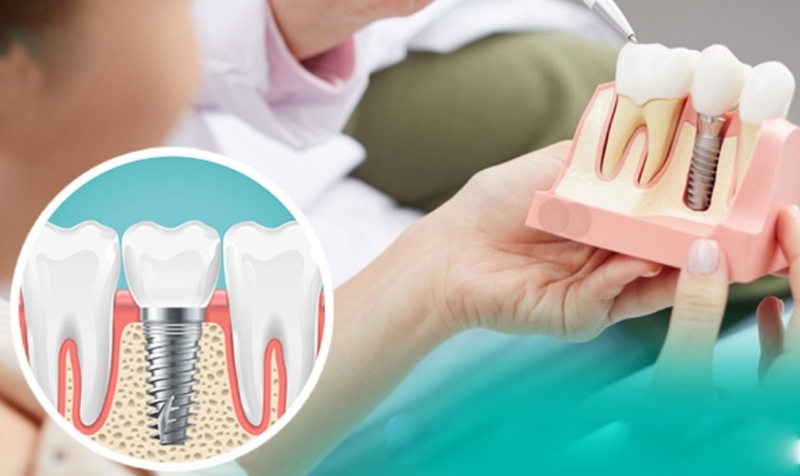 Đặt chân răng là giai đoạn đầu của quy trình trồng răng Implant