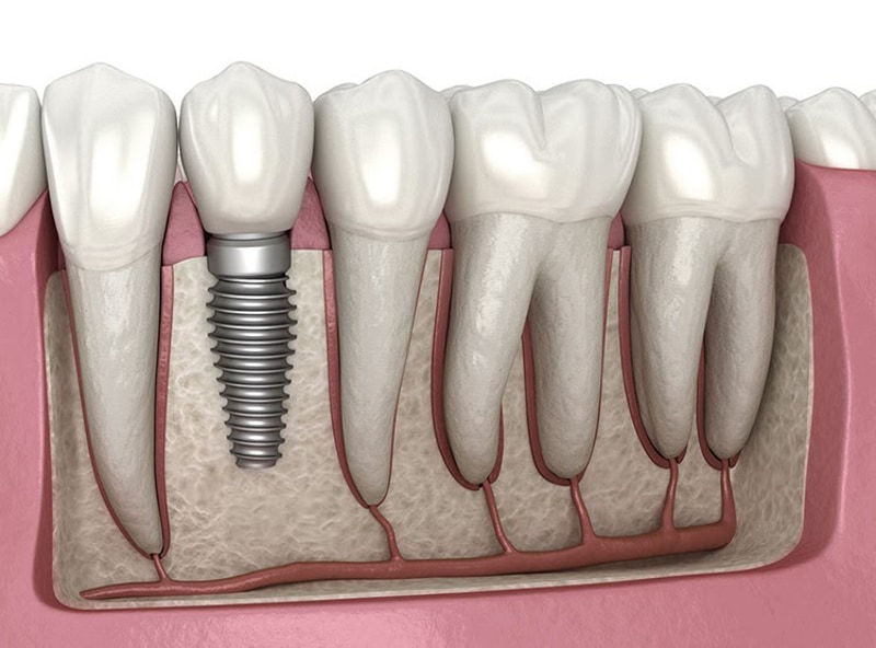 Quy trình trồng răng implant thông thường mất từ 3 – 6 tháng 