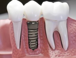 Bật mí các bước của quy trình trồng răng Implant tiêu chuẩn
