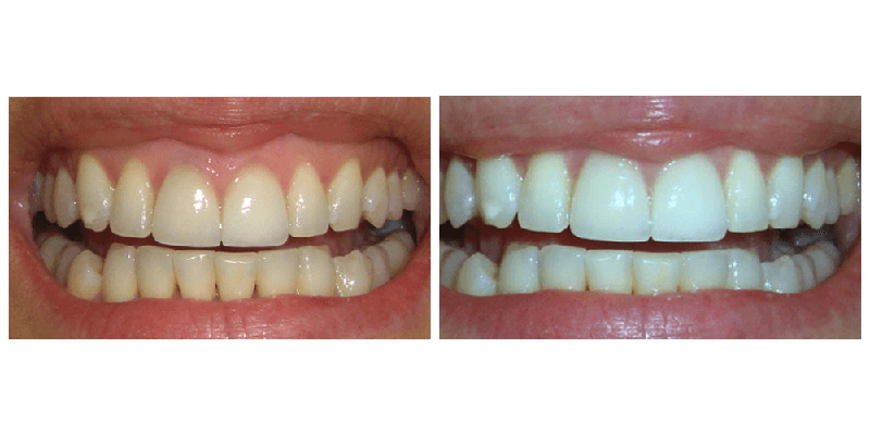 Răng trắng tự nhiên sau khi tẩy trắng tại Trung Tâm ViDental Clinic