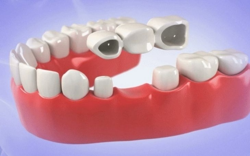 Trồng răng bắc cầu sứ được nhiều người sử dụng vì có tính thẩm mỹ cao
