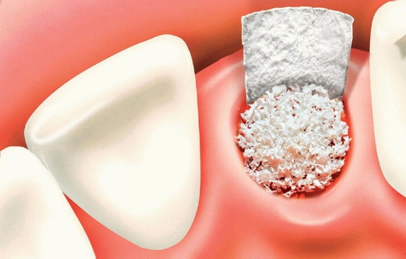 Mất răng quá lâu có thể dẫn tới tình trạng tiêu xương hàm