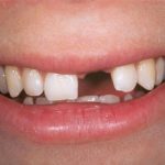 Trồng răng là kỹ thuật nha khoa duy nhất phục hình răng cửa đã mất