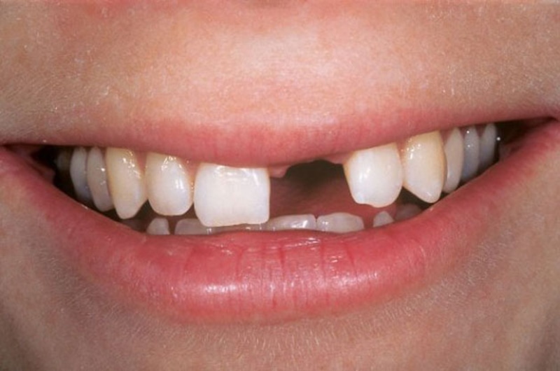 Trồng răng là kỹ thuật nha khoa giúp phục hình răng cửa đã mất