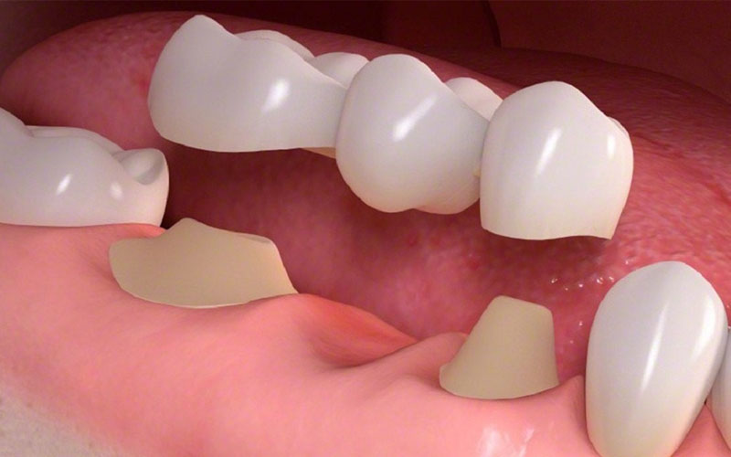 Trồng răng giả cố định giá bao nhiêu phụ thuộc vào nhiều yếu tố