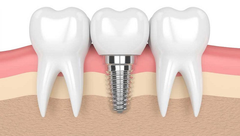 Phương pháp cấy ghép Implant được ứng dụng phổ biến trong trồng răng hàm