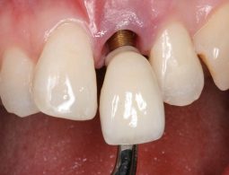 [Góc Nhìn Chuyên Gia] Trồng Răng Implant Có Nguy Hiểm Không?