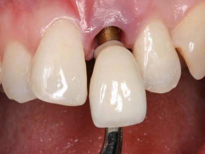 [Góc Nhìn Chuyên Gia] Trồng Răng Implant Có Nguy Hiểm Không?
