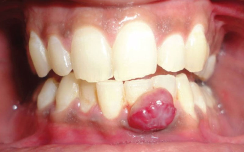 Trồng răng Implant giá rẻ nguy cơ gây ra các bệnh lý răng miệng
