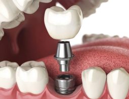 Tìm Hiểu Về Trồng Răng Implant Trả Góp Và Lưu Ý Khi Thực Hiện