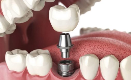 Tìm Hiểu Về Trồng Răng Implant Trả Góp Và Lưu Ý Khi Thực Hiện