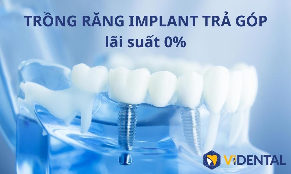 Trồng răng Implant tại Vidental được trả góp với lãi suất 0%