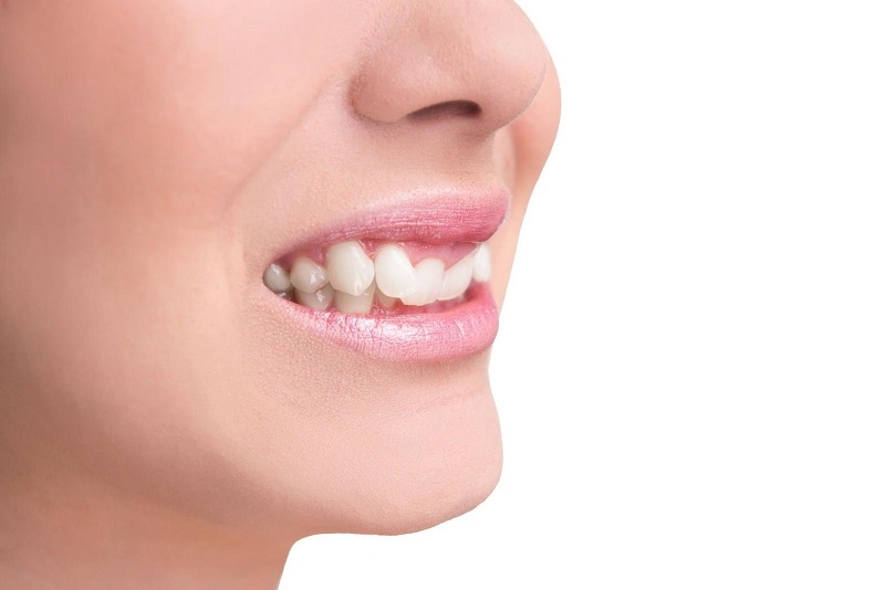 Trồng răng khểnh có đau không là thắc mắc thường gặp