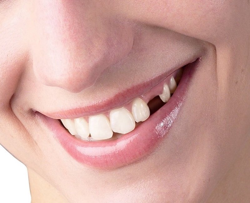 Cấy ghép implant được áp dụng trong những trường hợp mất răng