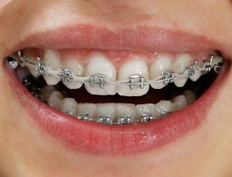 Niềng răng mắc cài kim loại là phương pháp chỉnh nha được nhiều người lựa chọn