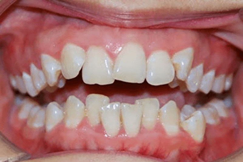 Mức độ lệch lạc của răng cũng quyết định giá niềng răng mắc cài kim loại