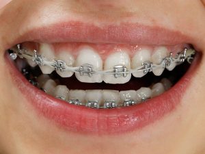Niềng răng mắc cài kim loại là phương pháp chỉnh nha được nhiều người lựa chọn