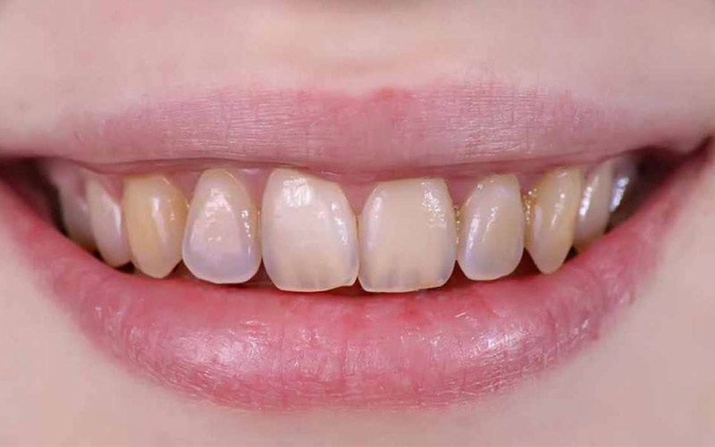 Men răng là lớp nằm ở ngoài cùng và bao phủ bên ngoài răng