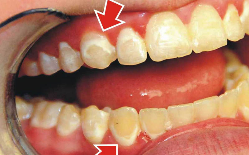 Tình trạng thiếu sản men răng