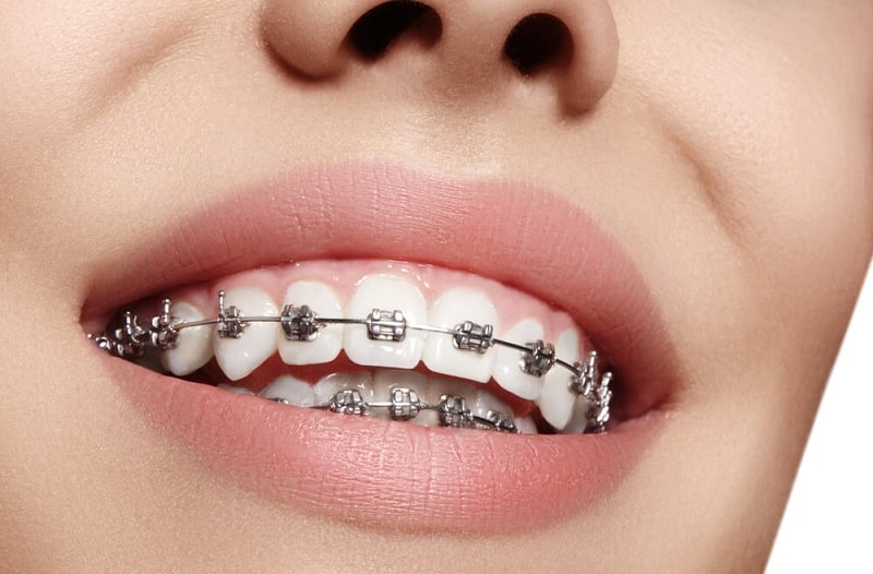 Niềng răng bao lâu được tháo là thắc mắc thường gặp