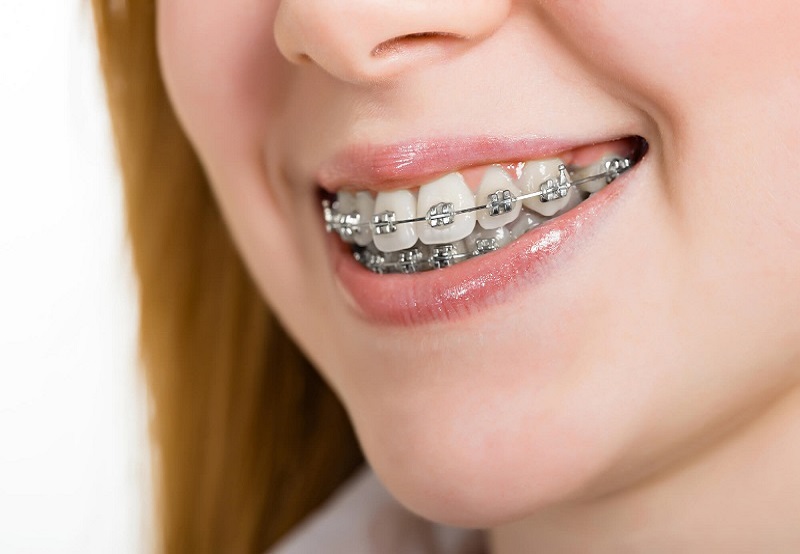 Niềng răng được chia thành nhiều giai đoạn khác nhau