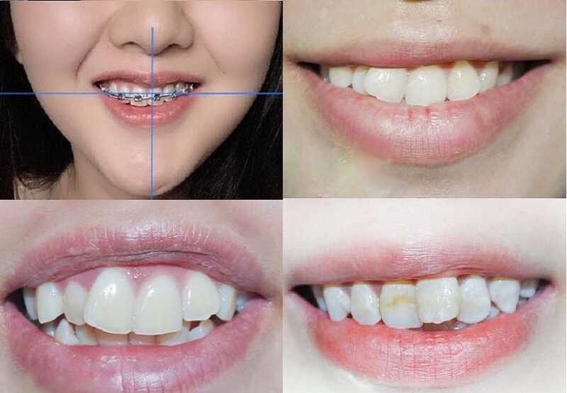 Có nhiều nguyên nhân dẫn đến tình trạng niềng răng bị lệch mặt