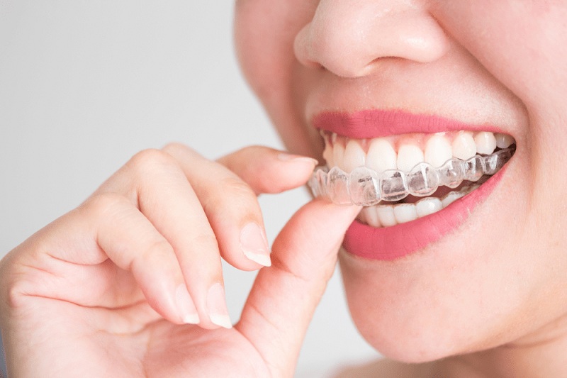 Hàm duy trì được khuyến cáo giúp chỉnh lệch mặt sau niềng răng
