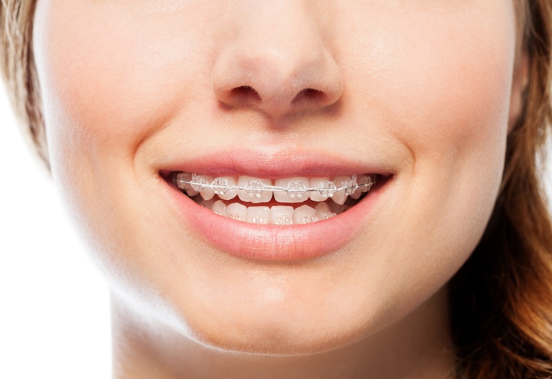Niềng răng cửa là gì, có những phương pháp nào là thắc mắc phổ biến