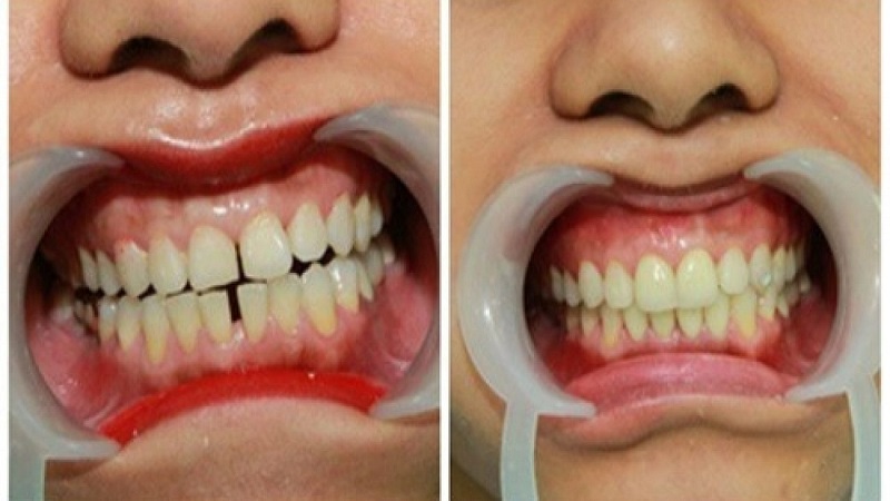 Trám răng là phương pháp truyền thống