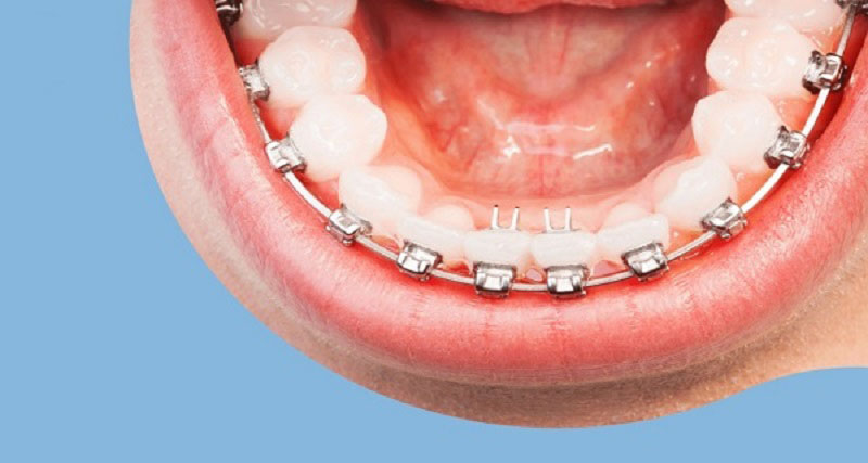 Niềng răng hàm dưới hiệu quả thường không cao so với hai hàm
