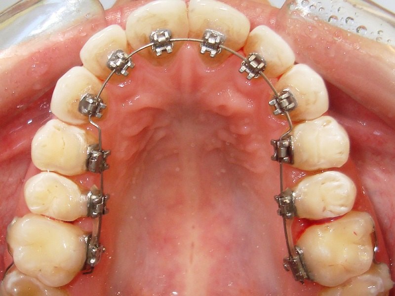 Niềng răng hàm trên là vấn đề được nhiều người quan tâm