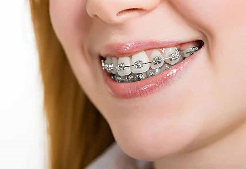 Niềng răng là phương pháp sở hữu nhiều ưu điểm hấp dẫn