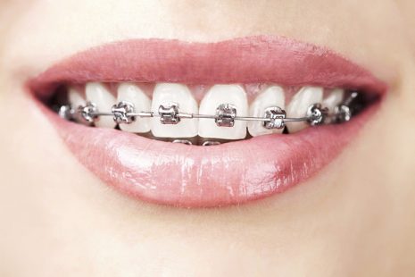 Niềng răng mắc cài kim loại tự đóng là lựa chọn của nhiều người
