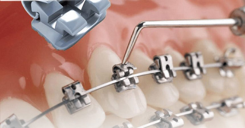 Mức giá niềng răng mắc cài kim loại tự buộc phụ thuộc vào nhiều yếu tố khác nhau