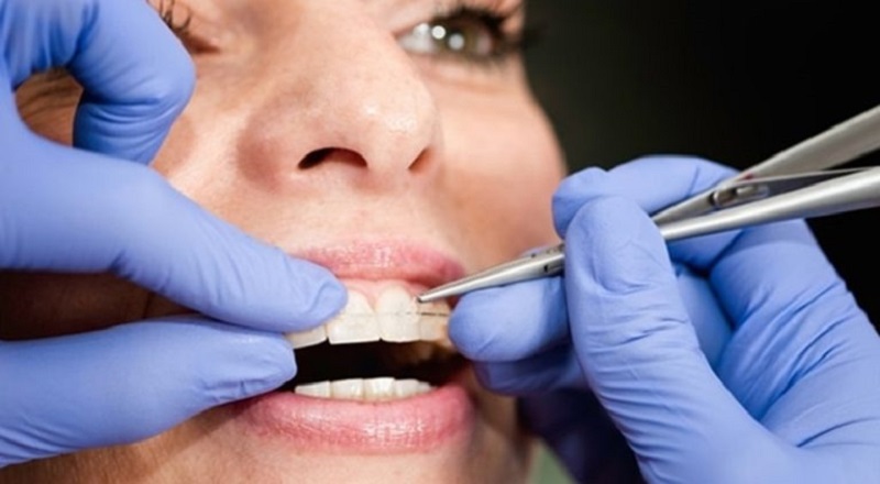 Quy trình niềng răng được thực hiện cẩn thận, tỉ mỉ