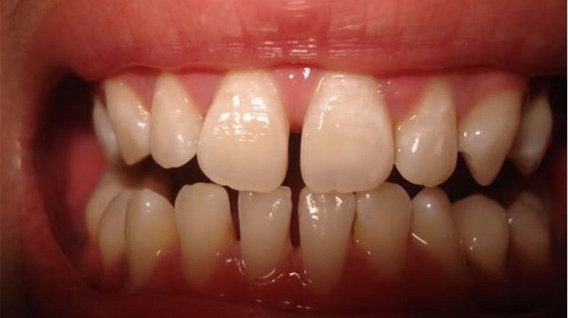Niềng răng mặt giúp khắc phục các vấn đề về thẩm mỹ răng miệng
