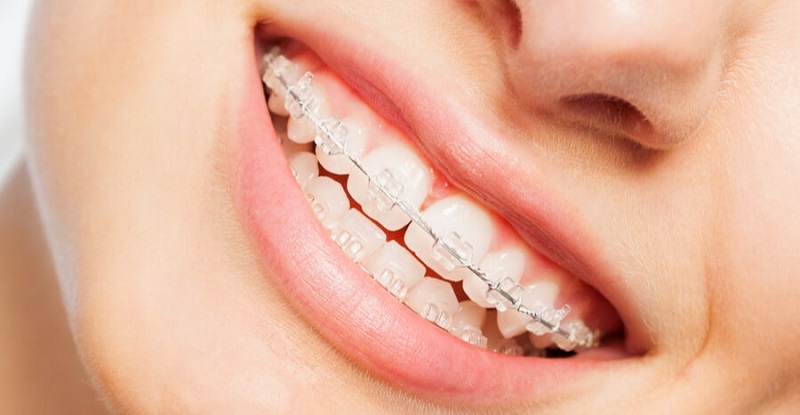 Niềng răng sứ có nhiều loại khác nhau