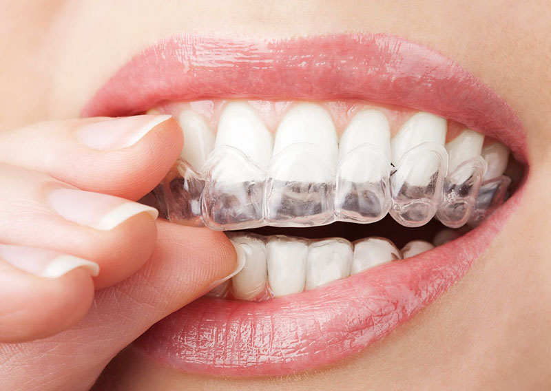 Hiện nay có rất nhiều phương pháp niềng răng trong suốt cho bạn lựa chọn