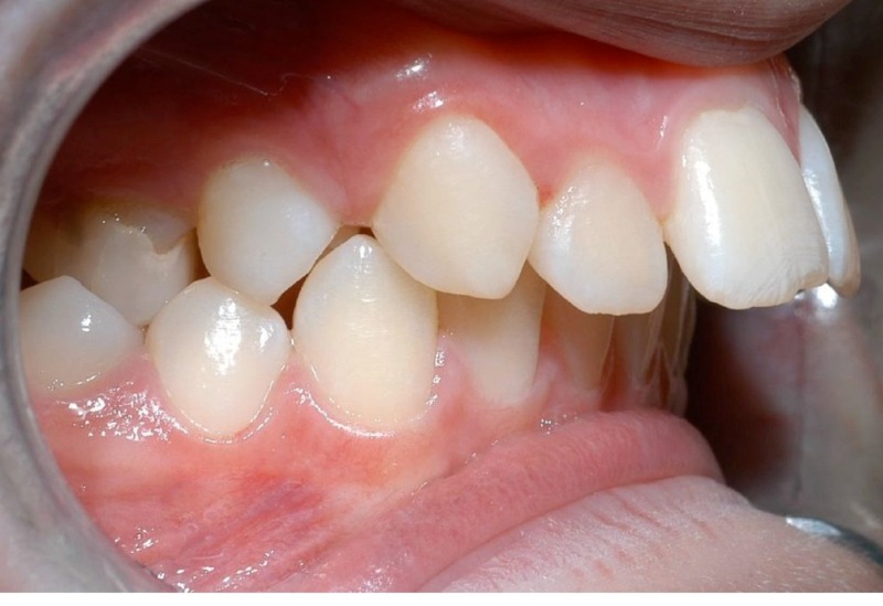 Răng vẩu thường gây mất thẩm mỹ cho người sở hữu