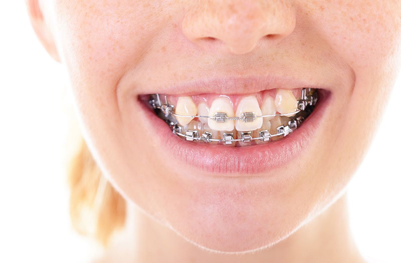 Thời gian chỉnh nha phụ thuộc vào phương pháp và độ lệch lạc của răng