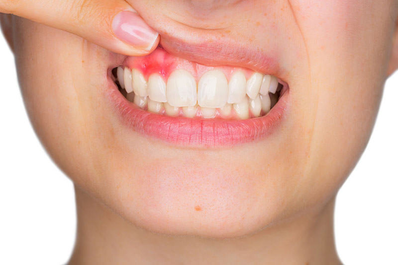 Vệ sinh răng miệng chưa tốt là nguyên nhân gây sưng lợi chảy máu chân răng